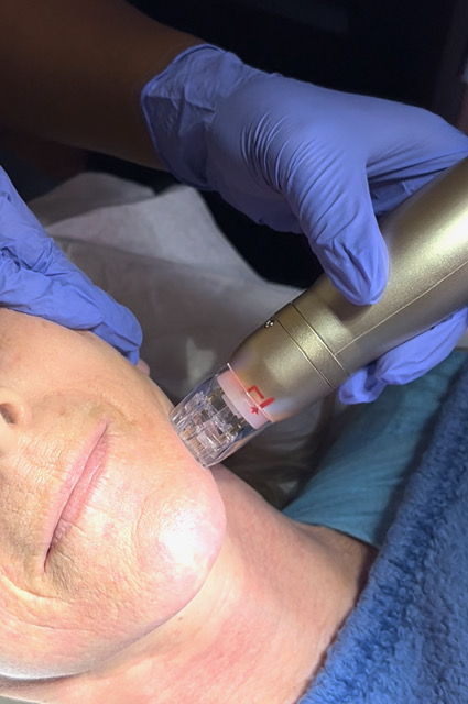 Catara Med Spa treatment in Algonquin, IL
