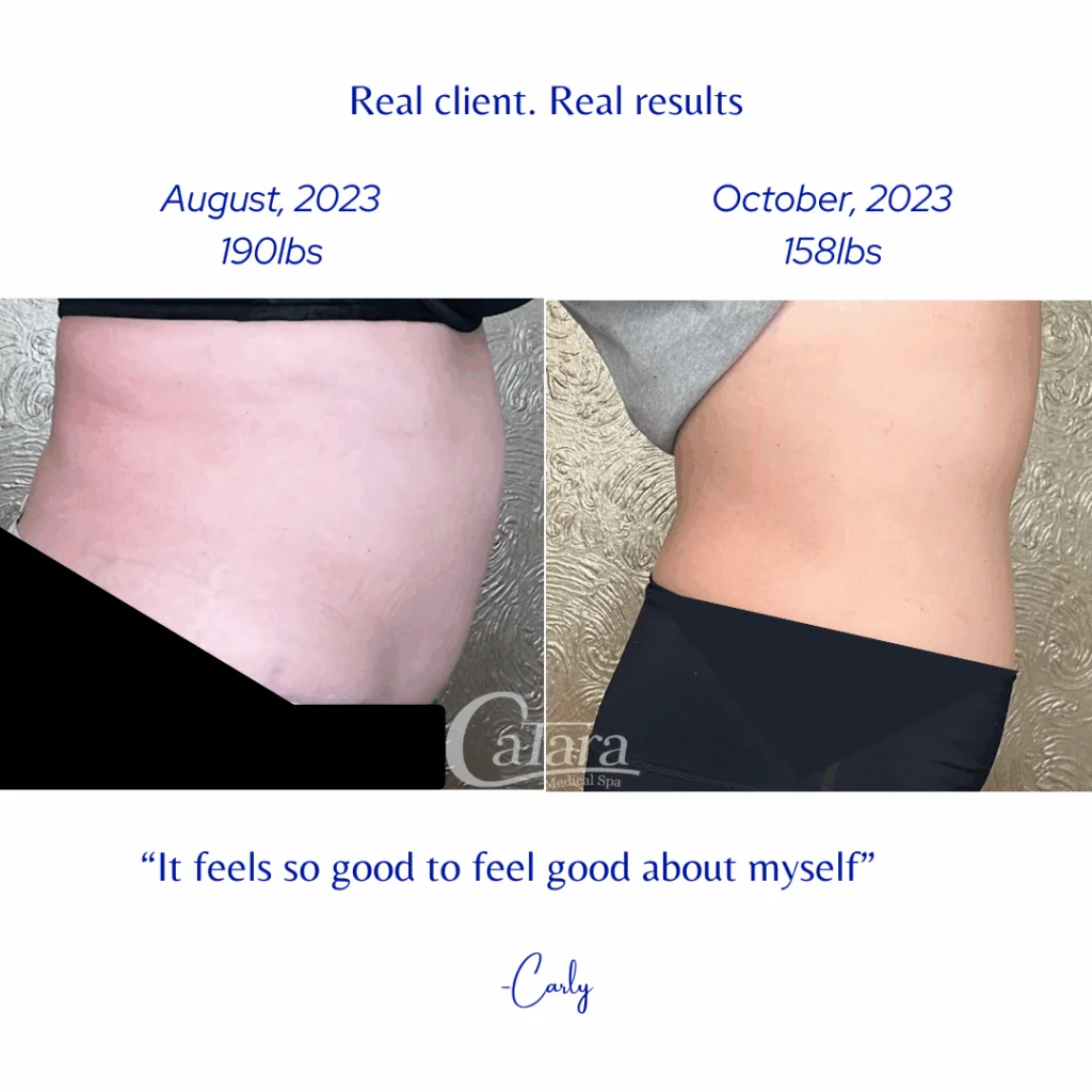 Real weight loss results at Catara Med Spa in Algonquin, IL, showing non-surgical midsection slimming