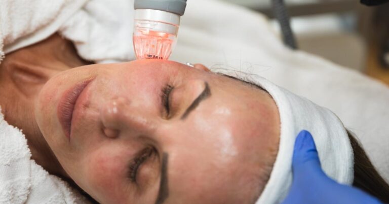 Featured image for Microneedling with PRP: Benefits and What to Expect