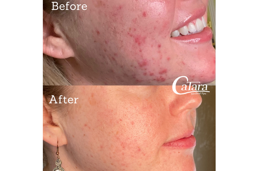 Two stacked close up photos of a cheek, an acne treatment before and after comparison captioned 'Before' and 'After', red blemishes visible in the upper frame.