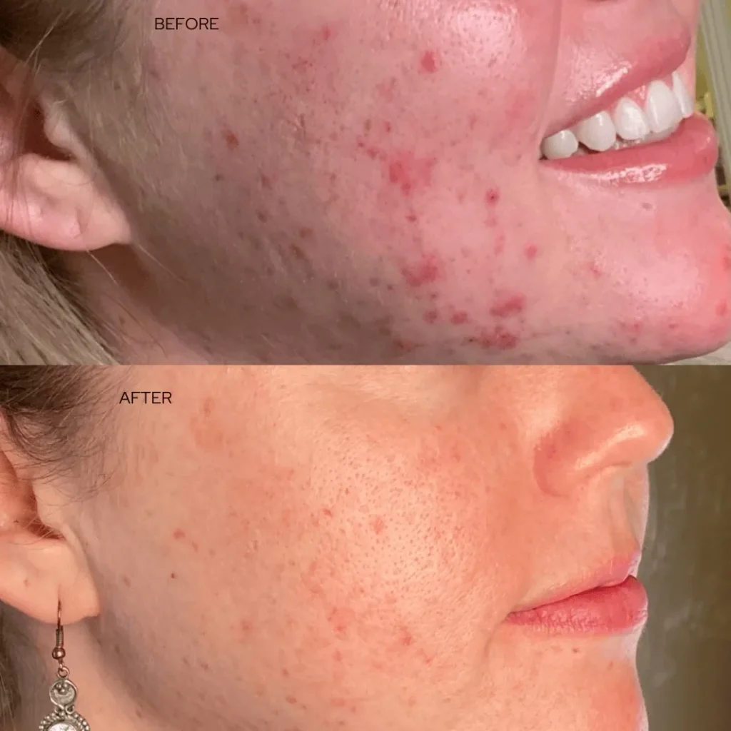 Two stacked photos labeled "Before" and "After" comparing a cheek with red inflamed acne to the same angle with no visible acne.