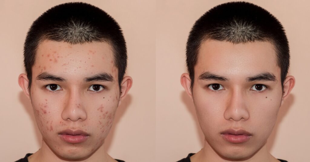 Two-panel graphic comparing a young man's face, red acne bumps visible on the cheek at left, unblemished skin in the same pose at right.