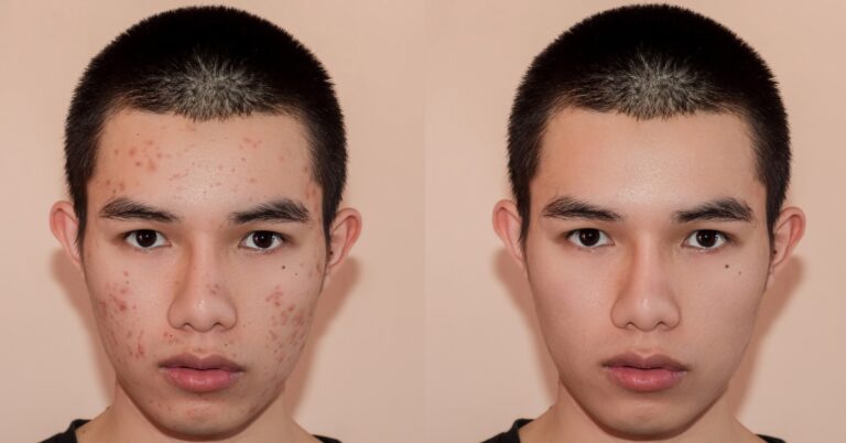 Featured image for Cystic Acne Treatment in Algonquin, IL