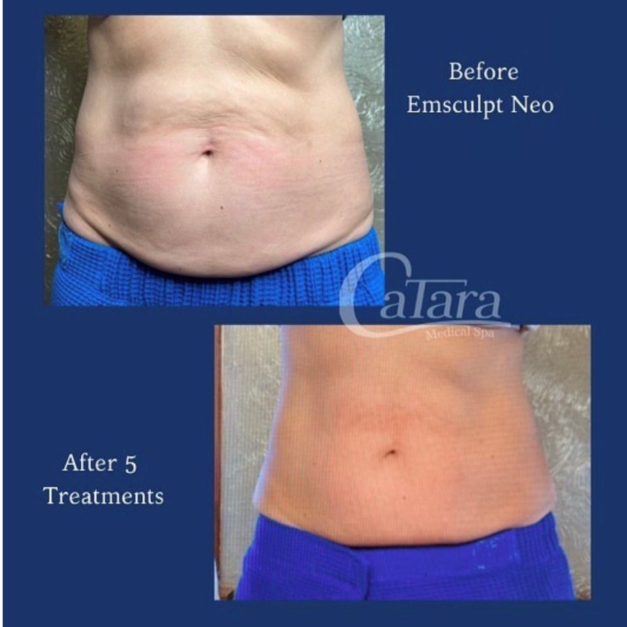 Before and after Emsculpt Neo treatment at Catara Med Spa in Algonquin, IL showing improved abdominal firmness.