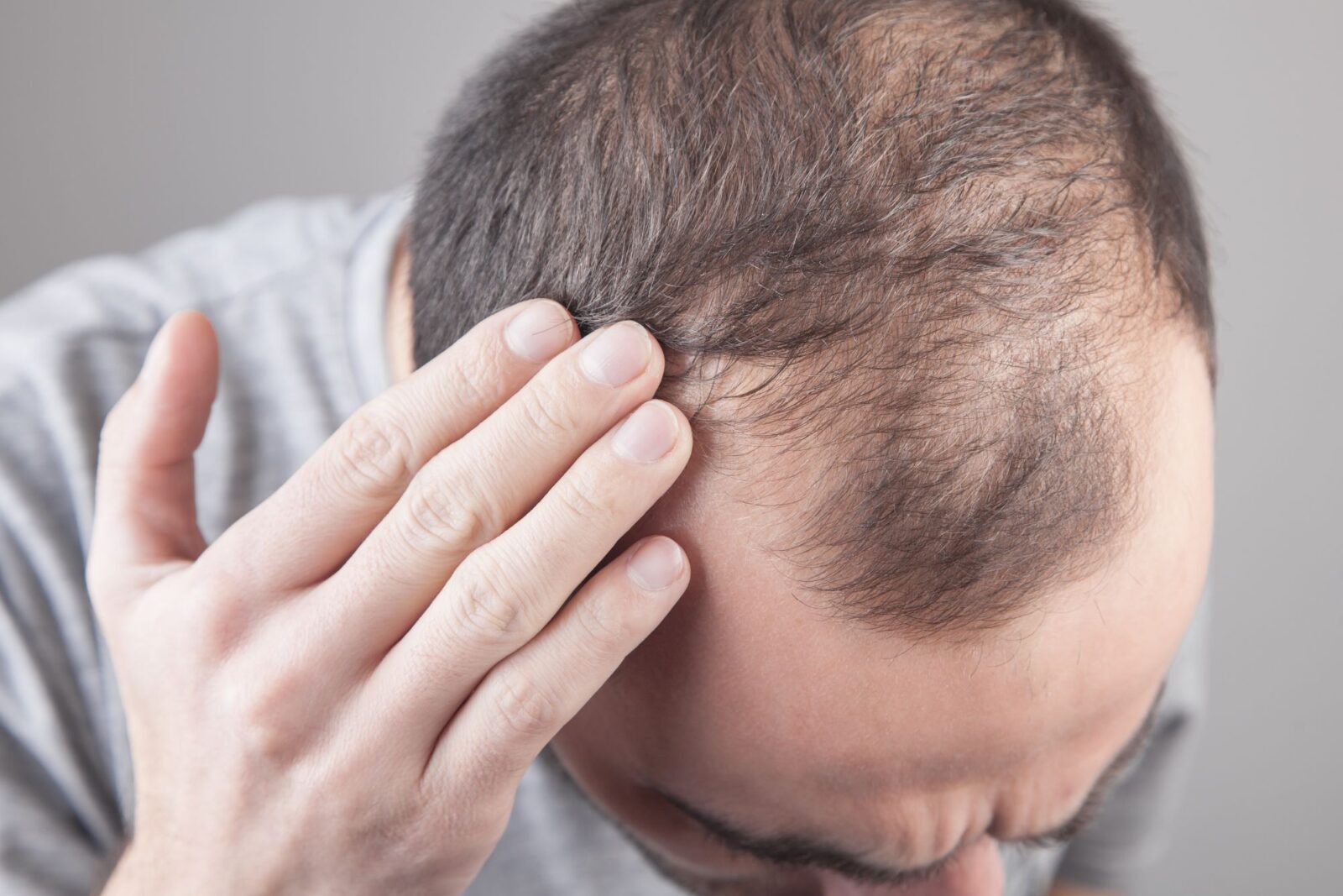 Man touching the top of his head with his fingers, showing visibly thinning hair and scalp at the crown, wearing a gray shirt.
