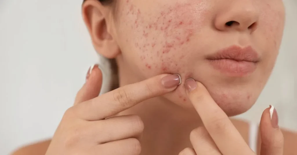 Close-up of two fingers pinching a cheek with visible red, inflamed acne bumps near the corner of the mouth.