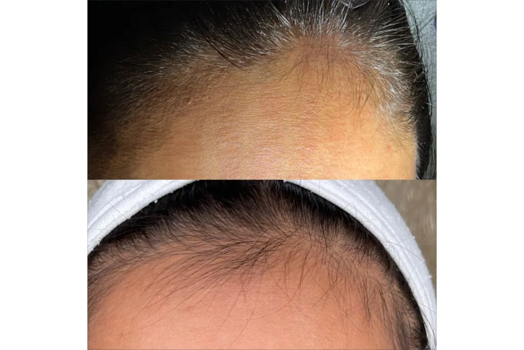 Before and after photo showing improved hair growth along the hairline