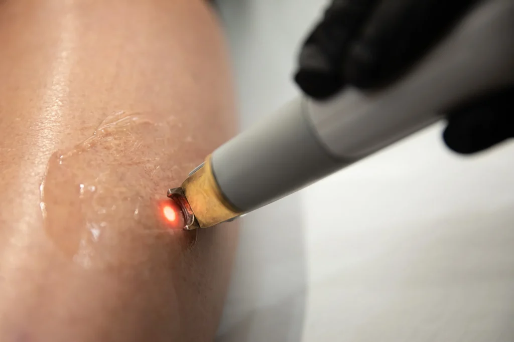 Gloved hand holding a laser handpiece with a glowing red light emitting from its gold tip onto oiled skin.
