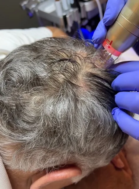 Overhead view of gloved hands parting a client's hair to apply a handheld microneedling device to the scalp during a PRP microneedling session at Catara Med Spa in Algonquin, IL.