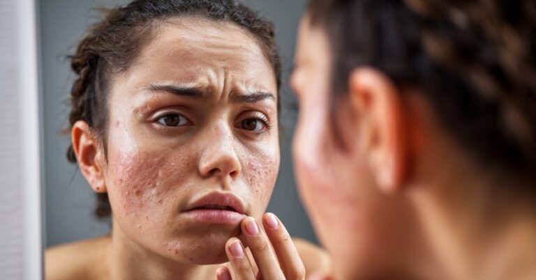 Featured image for How to Remove Acne Scars Naturally