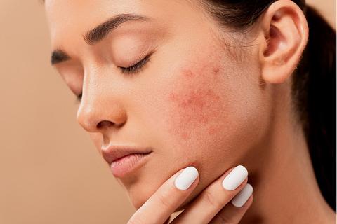 A close-up view of facial redness caused by rosacea, commonly treated at CaTara Med Spa in Algonquin with advanced laser and skincare options.