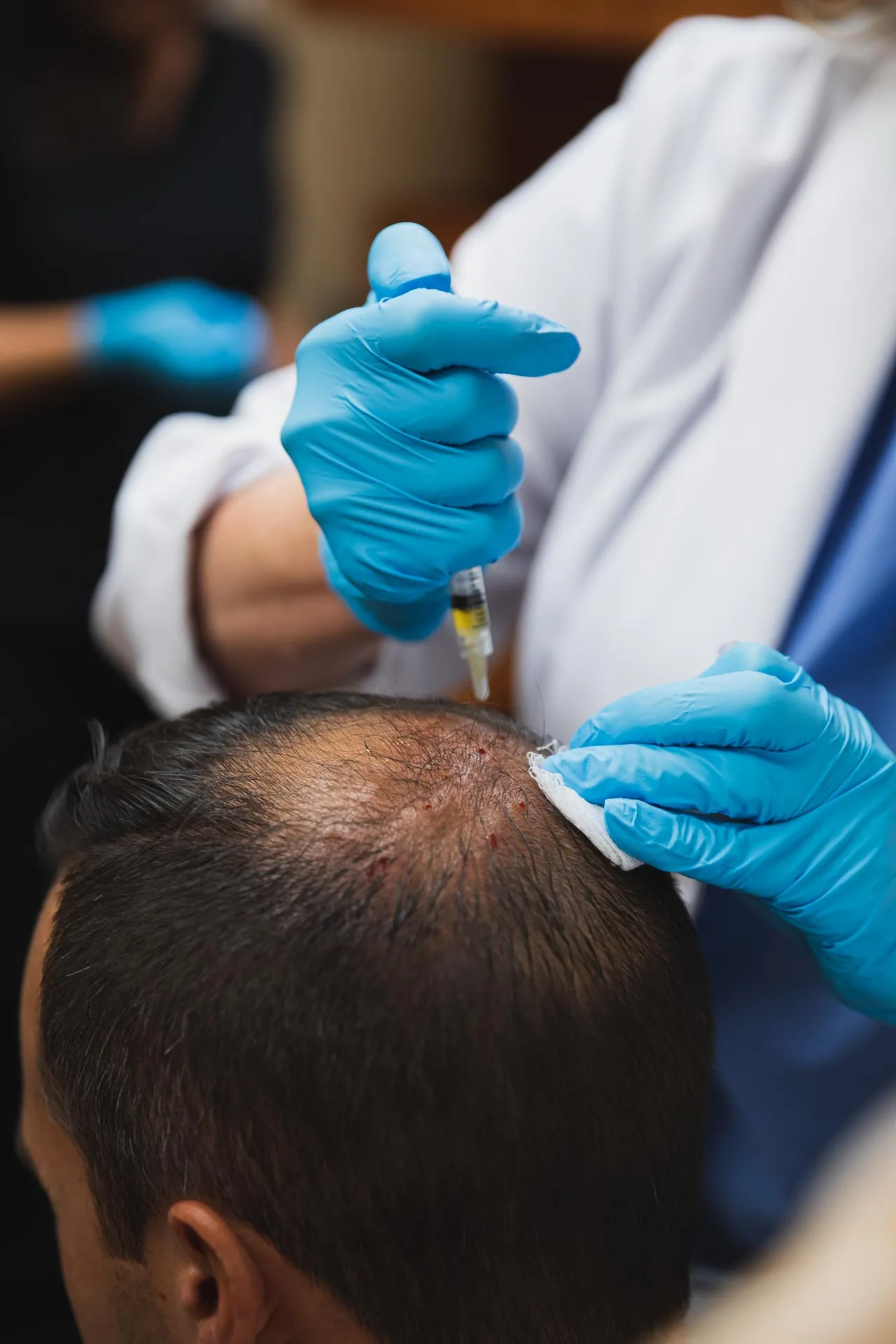 Gloved hand injecting PRP into a client's scalp near the hairline while another gloved hand presses gauze against the treated area at Catara Med Spa in Algonquin, IL.