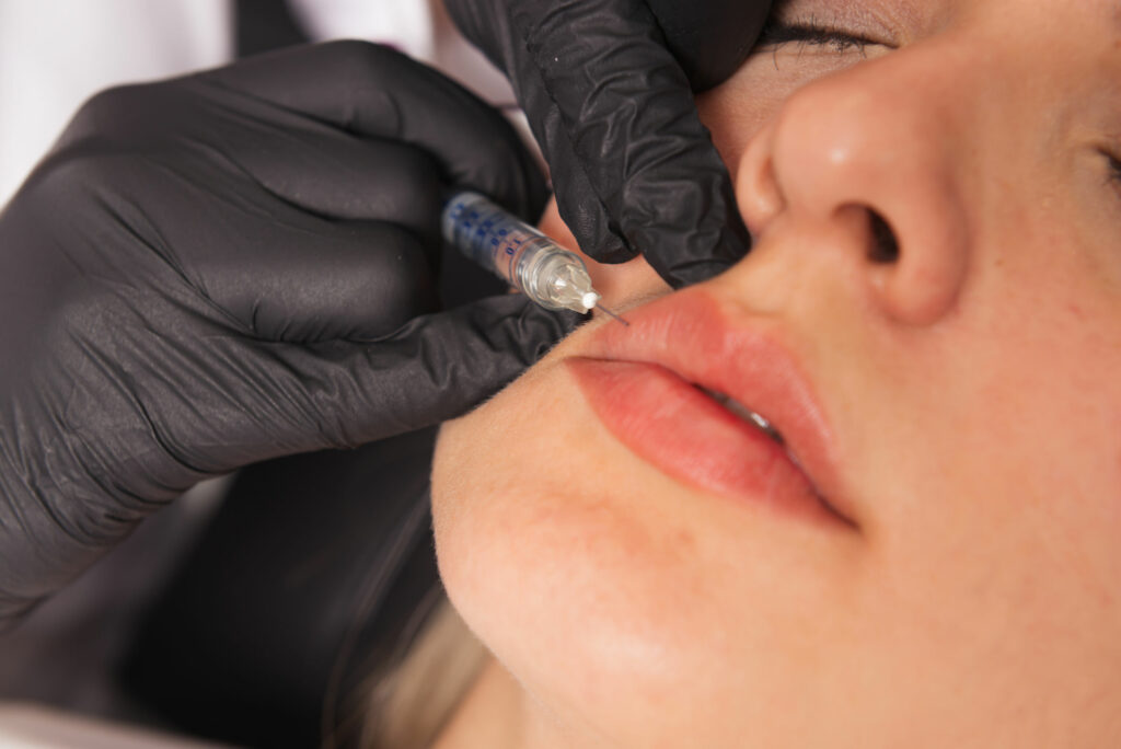 Black-gloved hand placing a fine needle at the upper lip corner during a lip flip treatment at Catara Med Spa in Algonquin, IL.