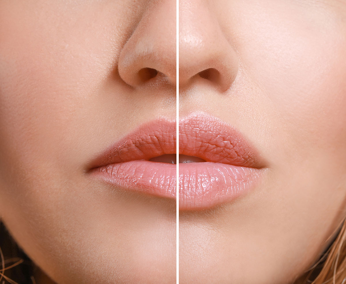 Before and after lip flip with Botox for a subtle upper lip lift at Catara Med Spa in Algonquin, IL