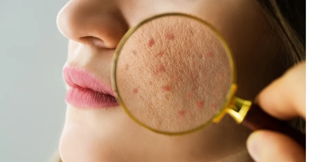 Magnifying glass held over a cheek, showing enlarged red acne bumps against the surrounding clear skin of the face.
