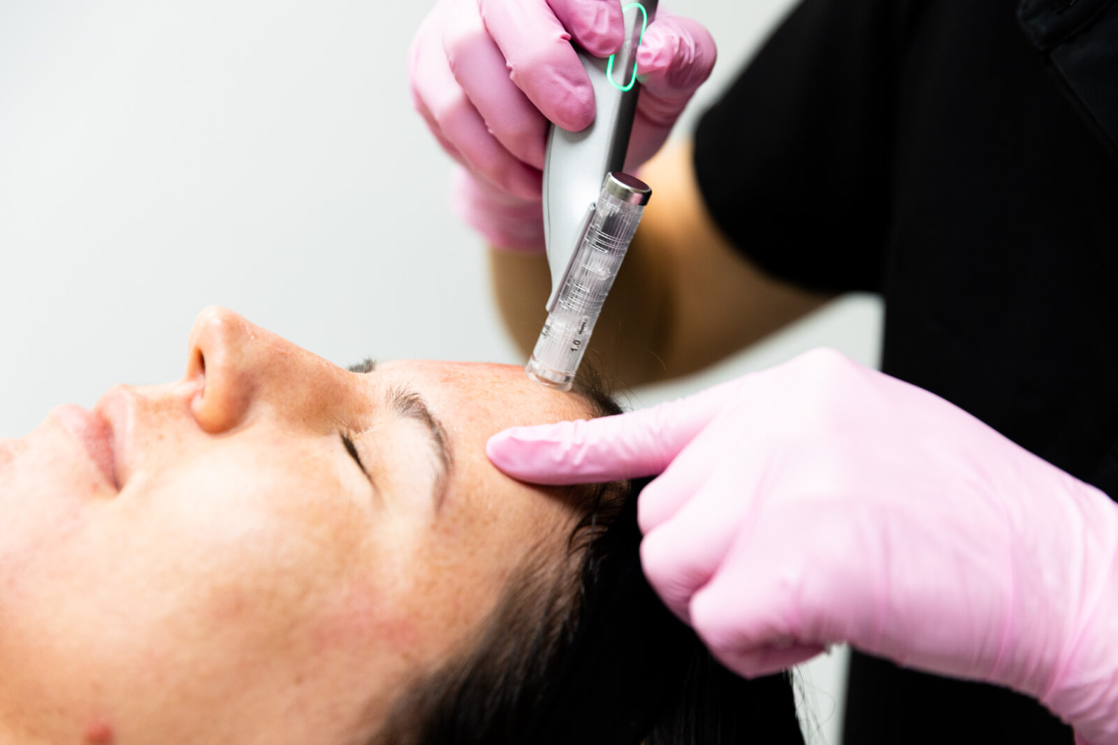 Pink-gloved hands hold a microneedling pen with a white cartridge tip near a person's forehead and hairline, eyes closed.