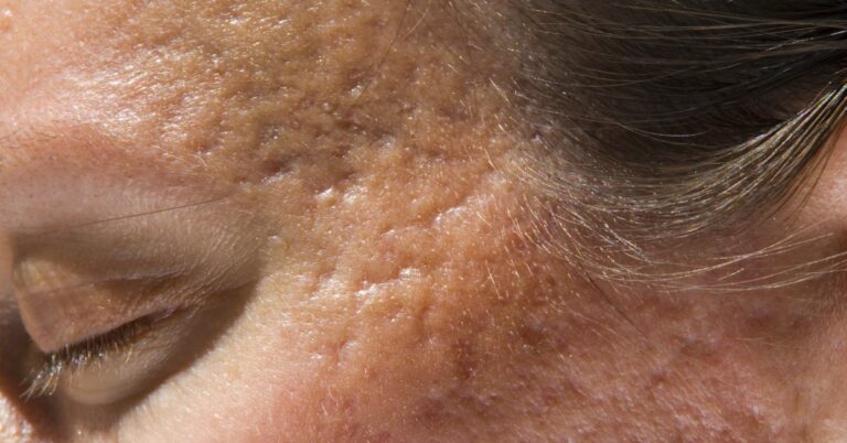 Featured image for Rolling Acne Scars: What They Are and How to Treat Them