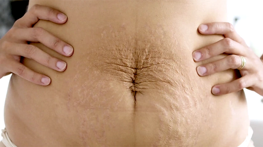 Close up of a bare lower abdomen with loose, creased skin around the navel, two hands resting at the waist on each side.
