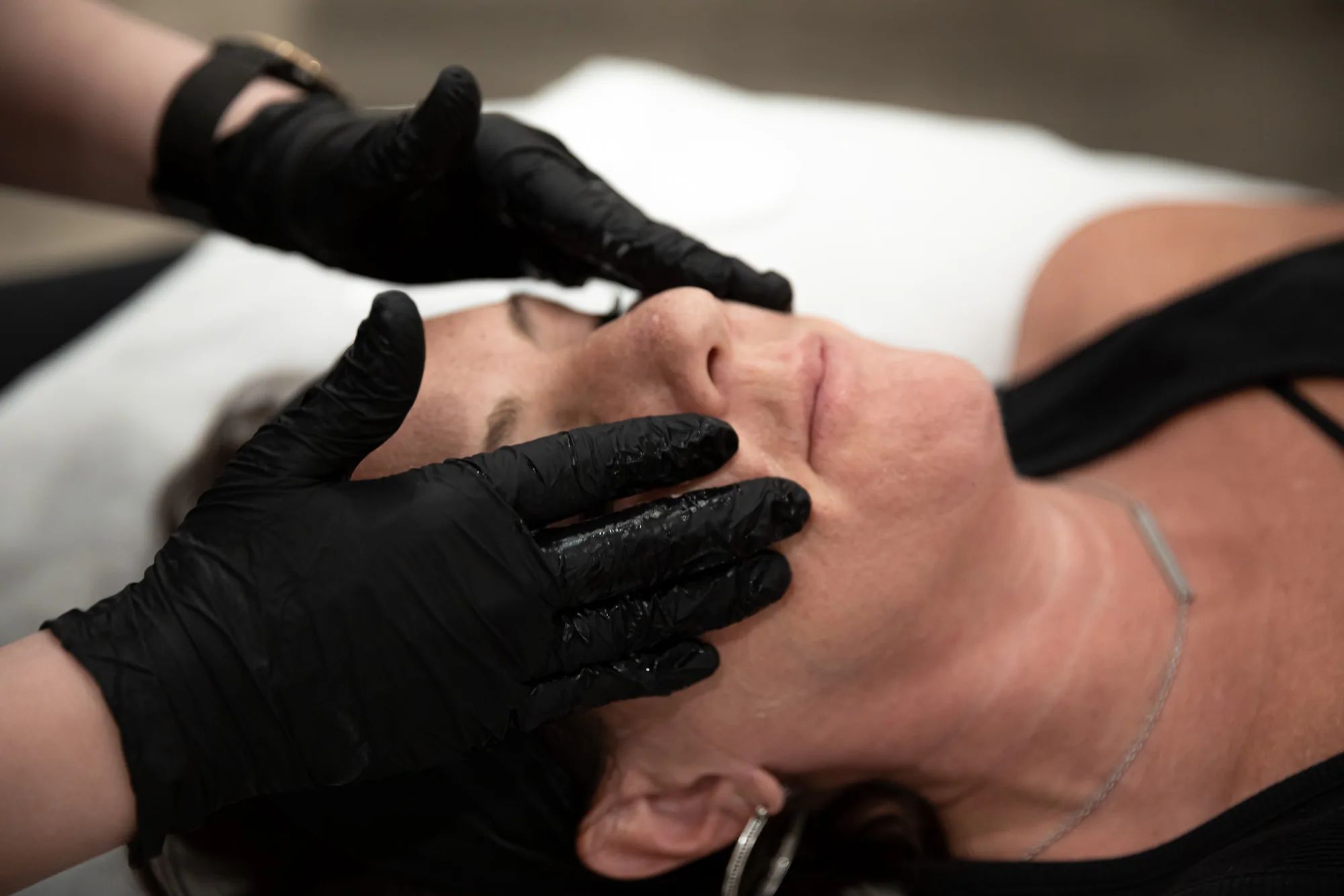 Provider in black nitrile gloves brushing a chemical peel solution across the cheek and jawline of a reclining client during a professional facial resurfacing treatment at Catara Med Spa in Algonquin, IL
