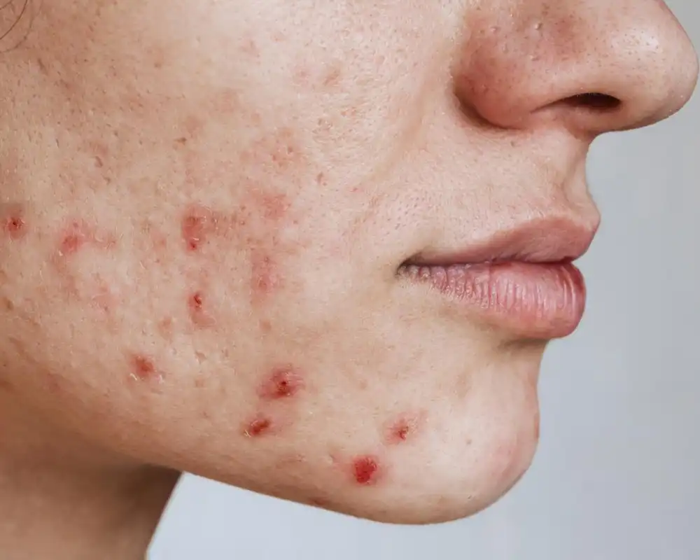 Acne treatment for acne-prone skin near Crystal Lake, IL
