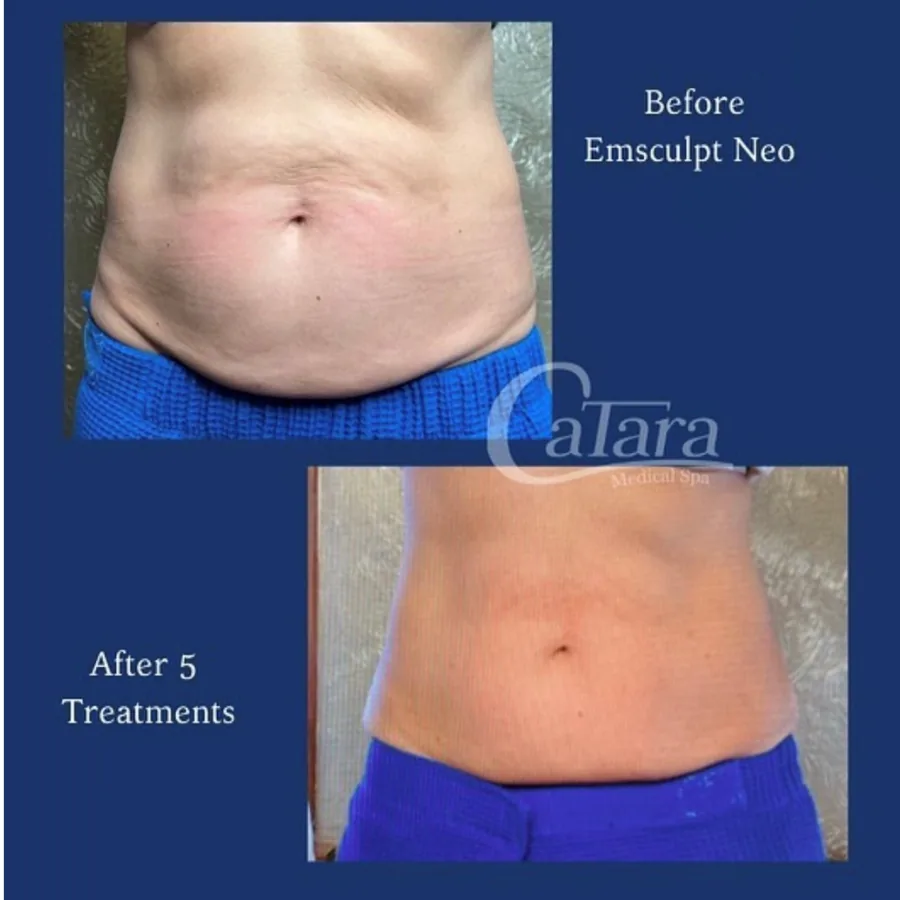 Before and after Emsculpt Neo treatment at Catara Med Spa in Algonquin, IL showing improved abdominal firmness.