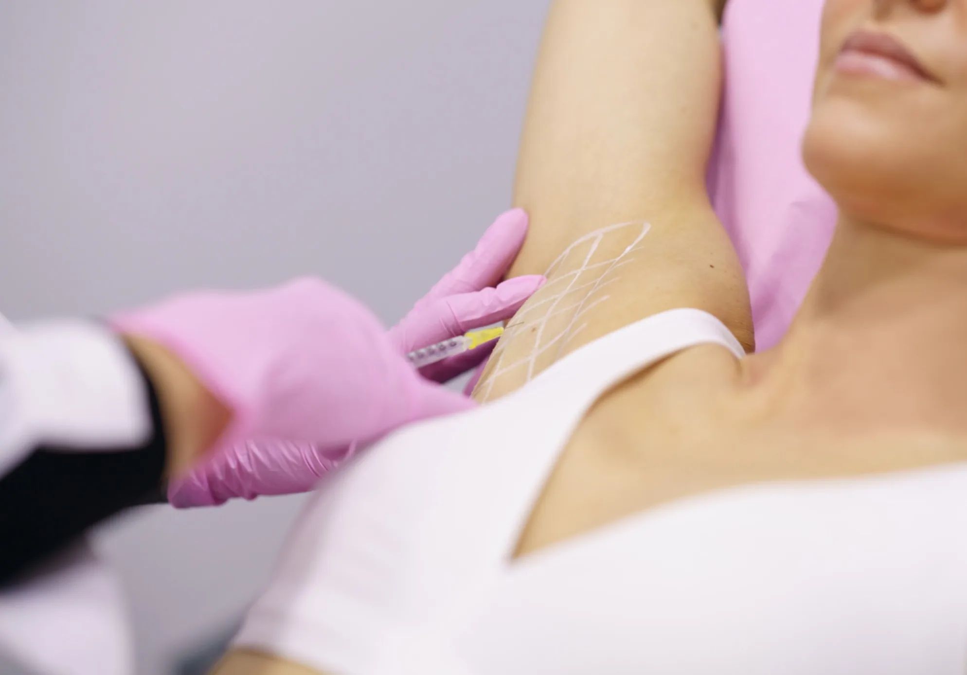 Injector placing a fine syringe into an underarm marked with a treatment grid during a hyperhidrosis appointment for excessive sweating at Catara Med Spa in Algonquin, IL