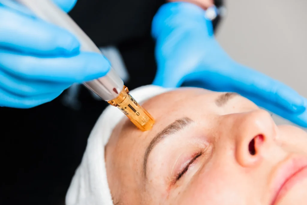 Provider guiding a microneedling pen with an amber needle cartridge across a client's forehead during a microneedling treatment at Catara Med Spa in Algonquin, IL